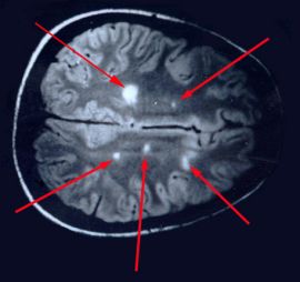 Lyme-Multiple-sclerosis.jpg
